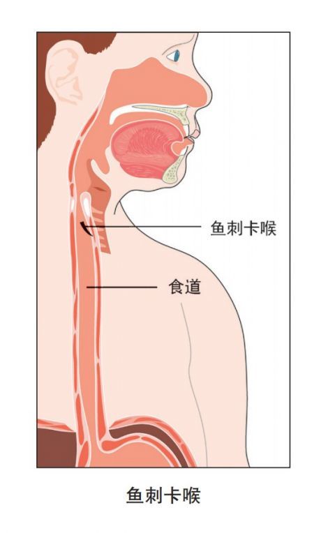鱼刺卡喉喝醋吞馒头这些错误的方法要避开
