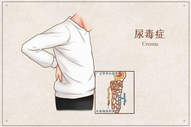 除了泡沫尿,这5种症状也是身体在求救!|尿毒症|肾病|肾脏