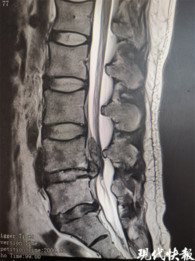 腰间盘突出磁共振图片图片