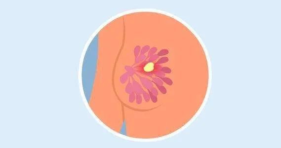 警惕越战越勇的乳腺分叶状肿瘤