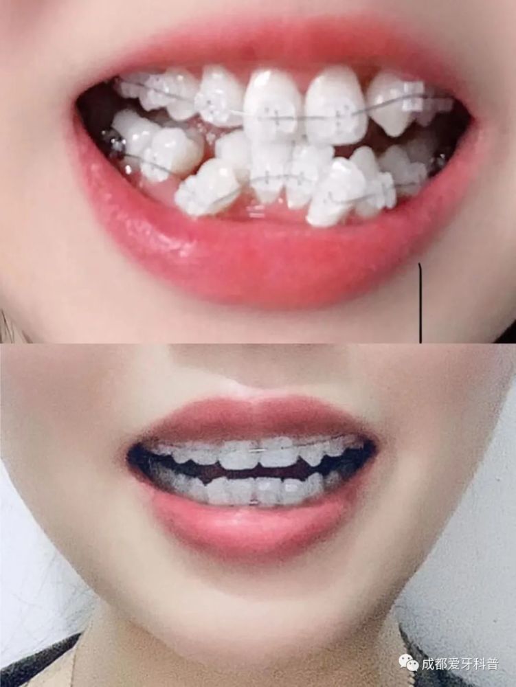 牙齿矫正拔牙对以后有影响吗 会有后遗症吗 腾讯新闻