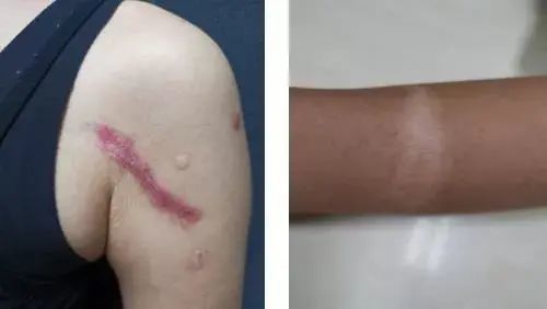 瘢痕和疤痕的区别 腾讯网
