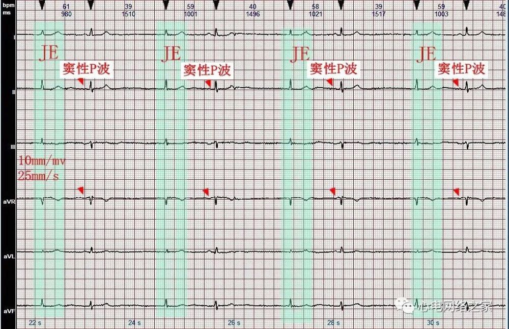 心電圖病例分析55交界性逸搏奪獲二聯律