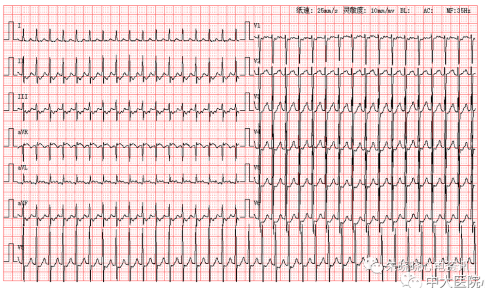 每日读图|第1646期 室早 左前分支传导阻滞_腾讯新闻