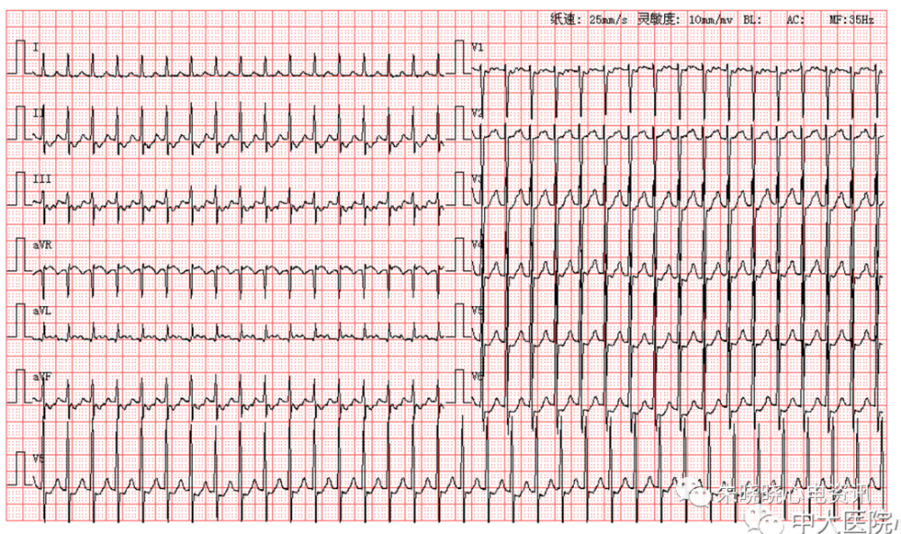 每日读图第1647期阵发性室上性心动过速
