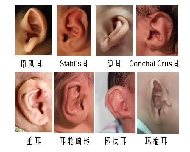 耳廓结构畸形是指胚胎发育早期耳部皮肤及软骨发育不全导致的外耳畸形