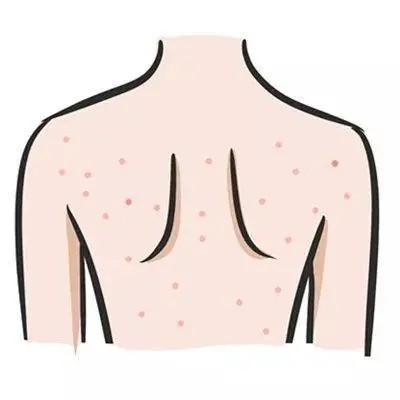 为什么背部总是长痘痘皮肤科医生主要是和这4种原因有关