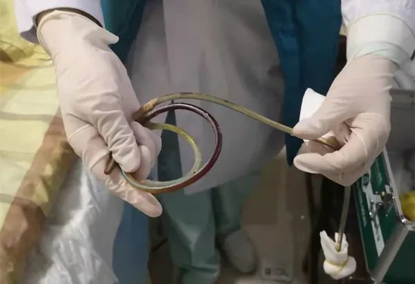 接着选取适合胃管,测量长度,清洁鼻孔,置管一次成功,期间王阿姨没有