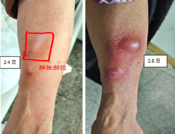 考虑血管条件欠佳,药物刺激性大,每日静脉留置针输液并当日拔除,2