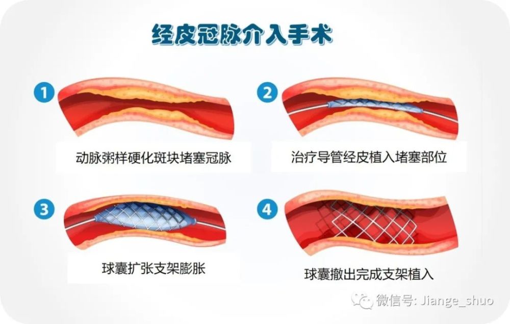 健哥说心脏有声版冠脉杂交手术集支架和搭桥优势于一身