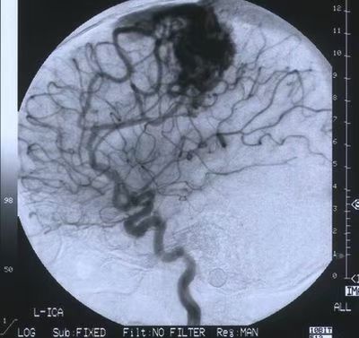 先天性脑血管畸形图片图片