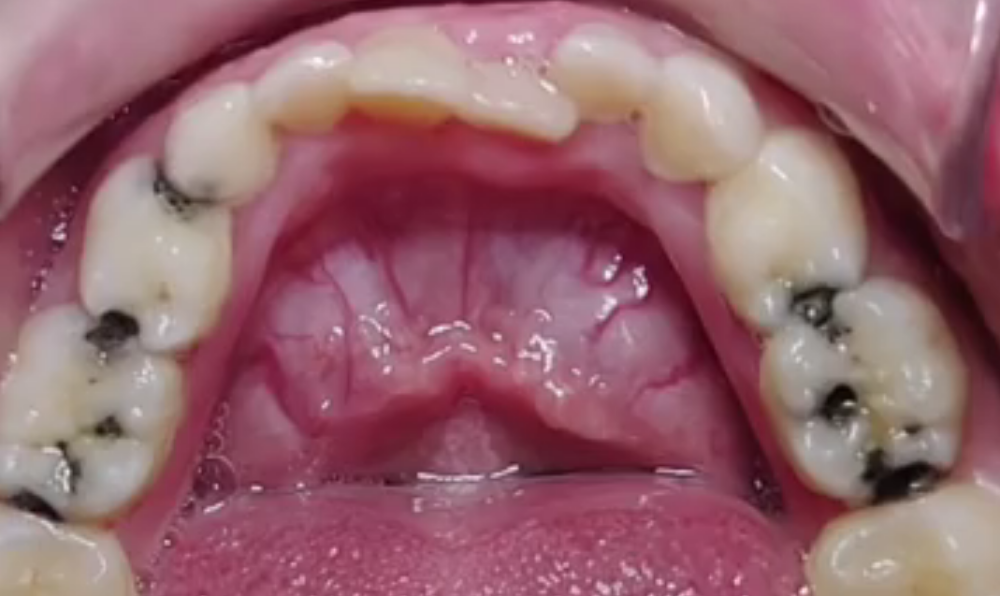 过早拔掉坏乳牙,当心新牙长不齐实际上,儿童的牙齿替换时间是有规律的