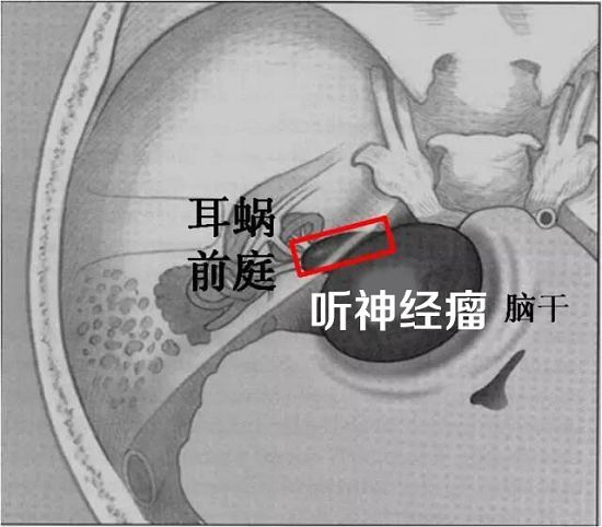 聽神經瘤開顱手術後多久能恢復正常