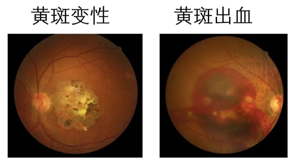 黃斑出血高度近視的人,由於眼球變大造成對眼球壁的不斷牽拉,就會引起