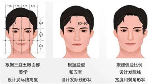 发际线种植是根据个人气质,三庭五眼,四高三低等审美理念进行脸型