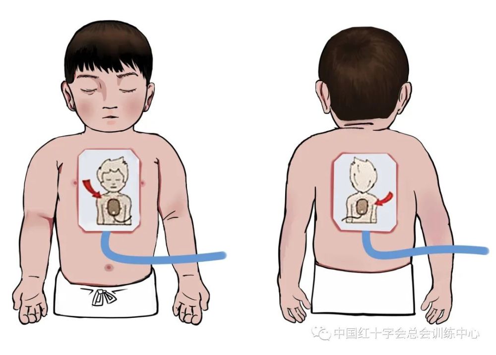 救在身边如何使用aed