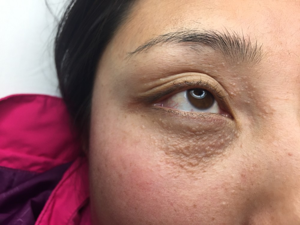 脸上有汗管瘤用维e乳有副作用可以直接涂脸上吗