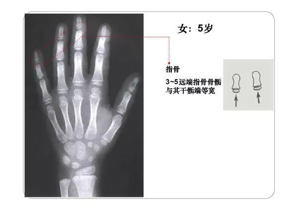 收藏必備丨骨齡圖譜