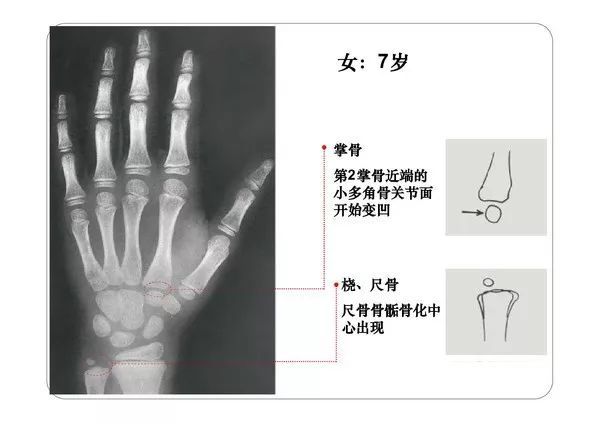 收藏必備丨骨齡圖譜