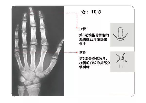 收藏必備丨骨齡圖譜