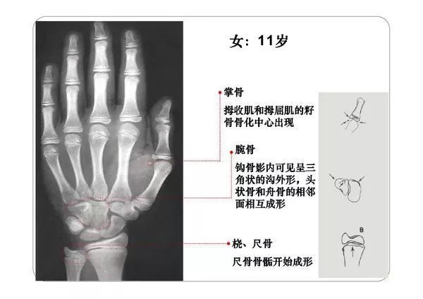 收藏必備丨骨齡圖譜