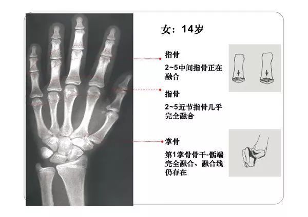 收藏必备丨骨龄图谱