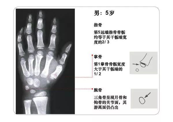 收藏必備丨骨齡圖譜