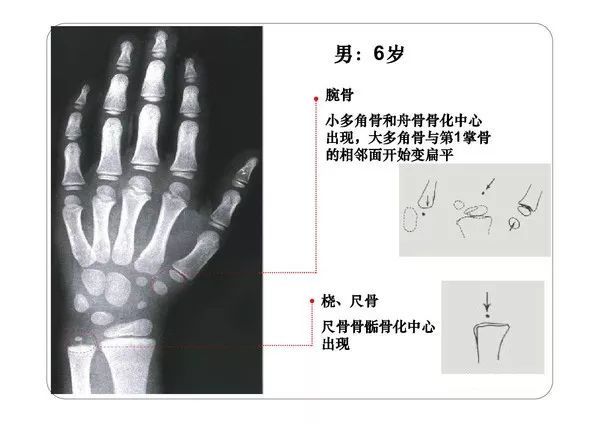 收藏必備丨骨齡圖譜