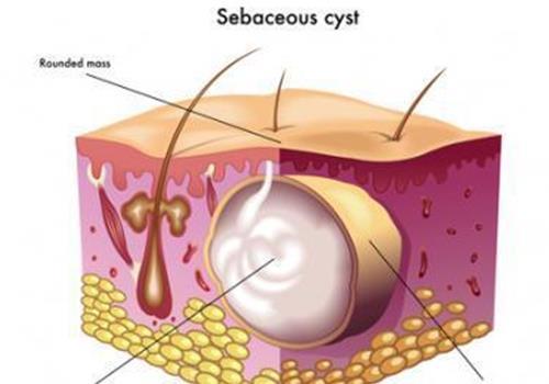 古代名将得了背疽之后往往难逃一死它到底是一种什么病