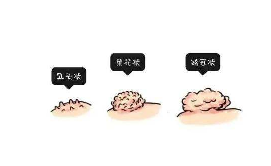 原本就是感染hpv引起的疣体,是由于持续感染低危hpv病毒引起的,这种疣