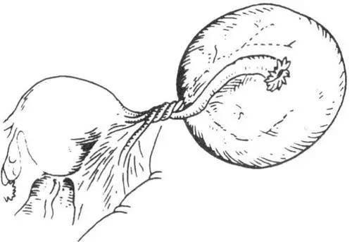 卵巢囊肿蒂扭转会导致输卵管卵巢充血,产生剧痛,并伴有恶心,呕吐等