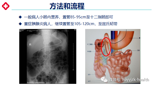 鼻肠管置入位置图片图片