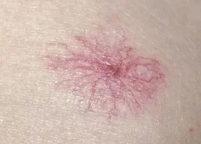 身上长这种痣的人肝多半不好千万别大意赶紧对镜自查