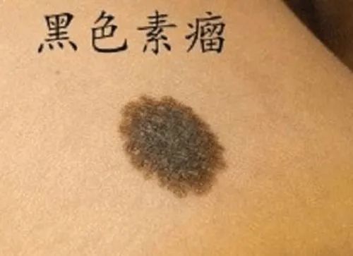 身上长这种痣的人肝多半不好千万别大意赶紧对镜自查