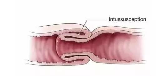 宝宝阵发性哭闹要警惕肠套叠这病怕拖24小时不治可能会断肠