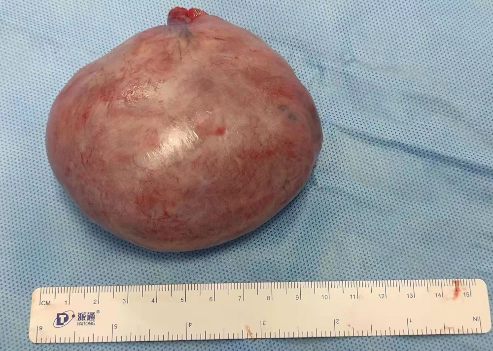 孕后期腹部疼痛一个巨型肿瘤悄然形成专家给广大女性提醒