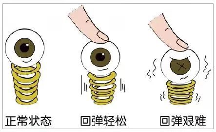 孩子近距离用眼时间长,负荷重,导致睫状肌持续收缩痉挛,晶状体不能