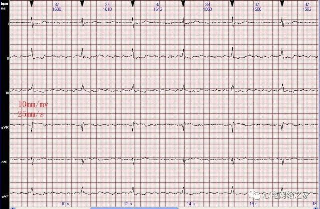 心电图病例分析58心房扑动伴三度房室传导阻滞
