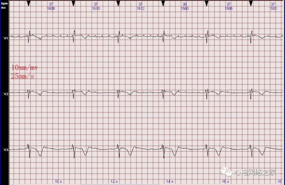 心電圖病例分析58心房撲動伴三度房室傳導阻滯