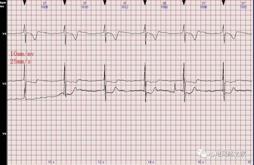 心電圖病例分析58心房撲動伴三度房室傳導阻滯