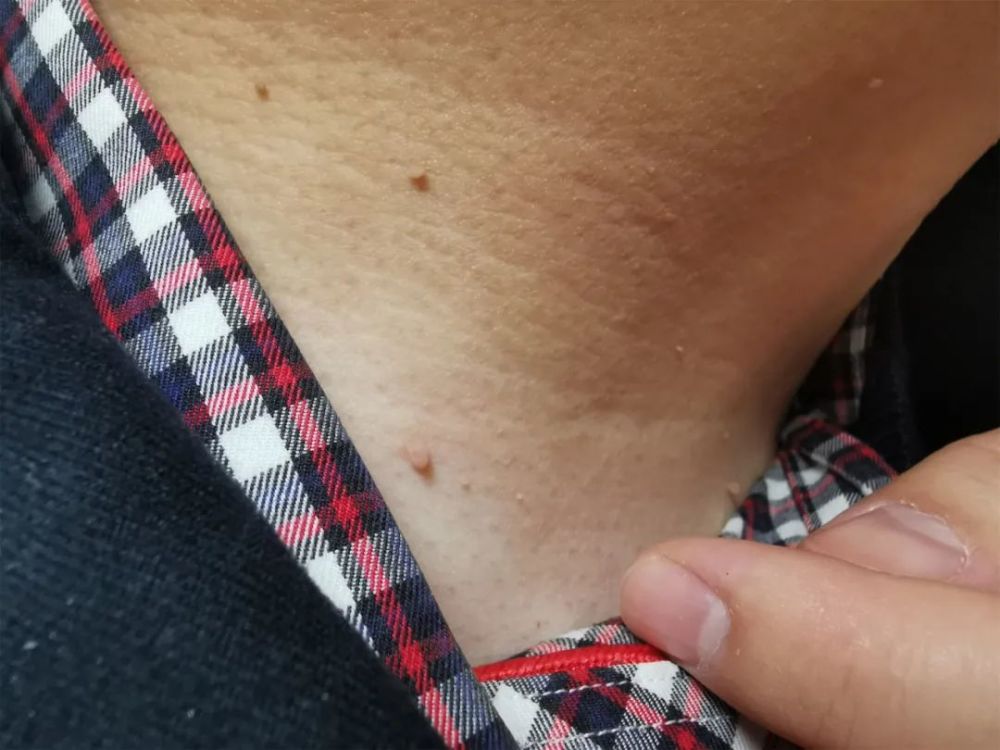 "医生,快帮我看看是不是人乳头瘤病毒感染了?
