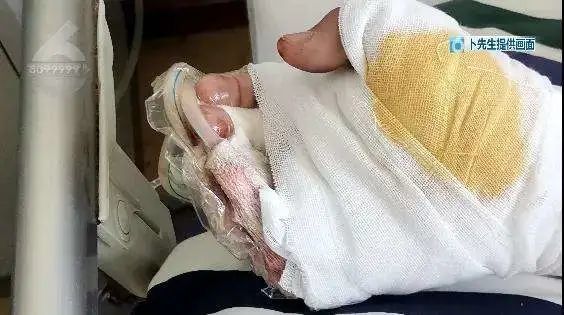 14岁少年放鞭炮炸断2根手指