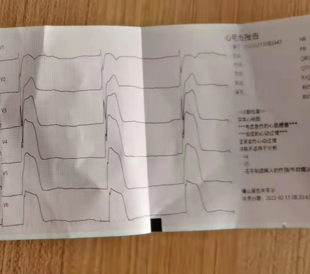 男子心梗心电图提示墓碑样心电图还没到医院人就没了