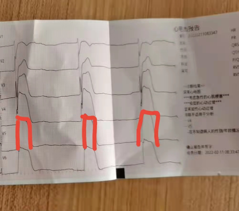 男子心梗心电图提示墓碑样心电图还没到医院人就没了