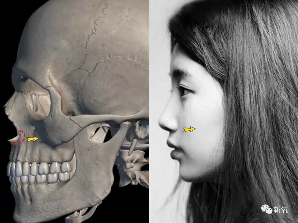 前文也提到过,鼻基底是上颌骨的一部分,位置上靠近梨状孔.