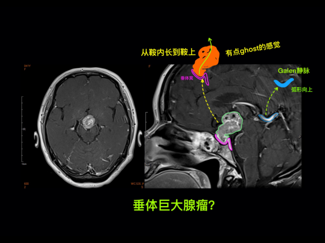 徐桂興手繪|顱腦解剖之鞍區病變影像(新)