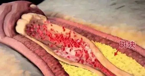 "瘀"造百病,灸通可以化瘀散结