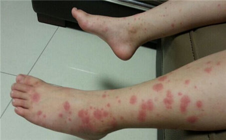 孩子身上出现紫红色小点,可能是这个病,家长要注意