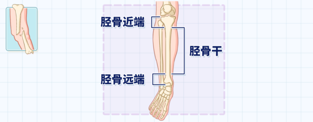 今天,我們主要聊聊脛骨骨折.由於脛骨,腓骨位置比較表淺