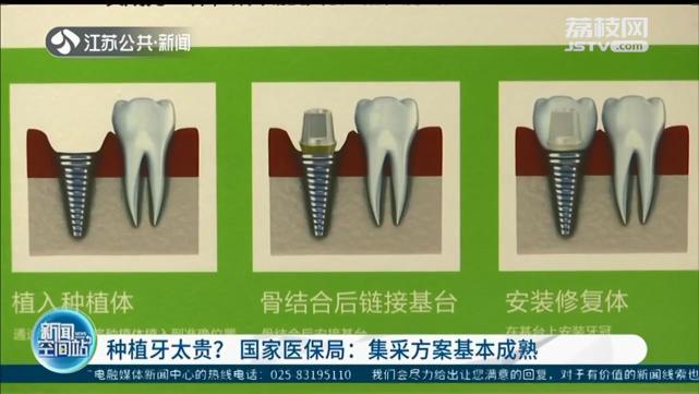 種植牙動輒一兩萬?國家醫保局:集中採購方案基本成熟